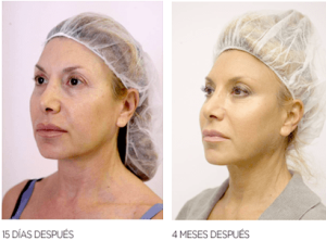 Efecto LIFTING natural INMEDIATO!