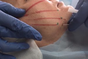 Hilos tensores Silhouette Soft: ¿cuánto dura su efecto?