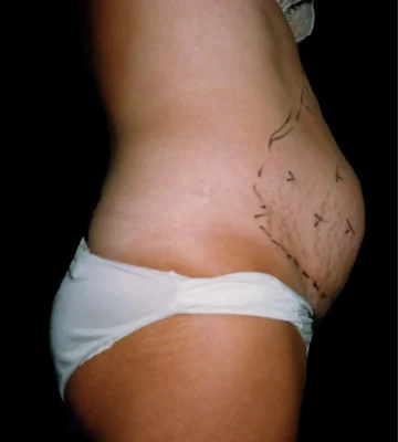 Lipolaser en abdomen - antes