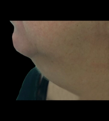 Lipolaser facial de papada - antes