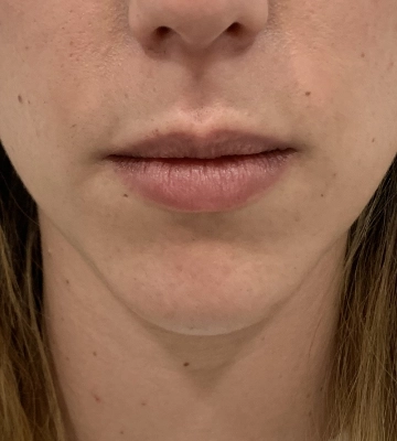 Relleno de labios - antes