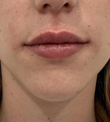 Relleno de labios - después