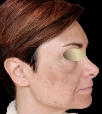 Tratamiento de manchas en la cara - Peeling - antes