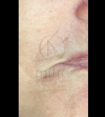 Mesoterapia facial - antes